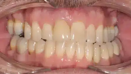 Final crown close up1