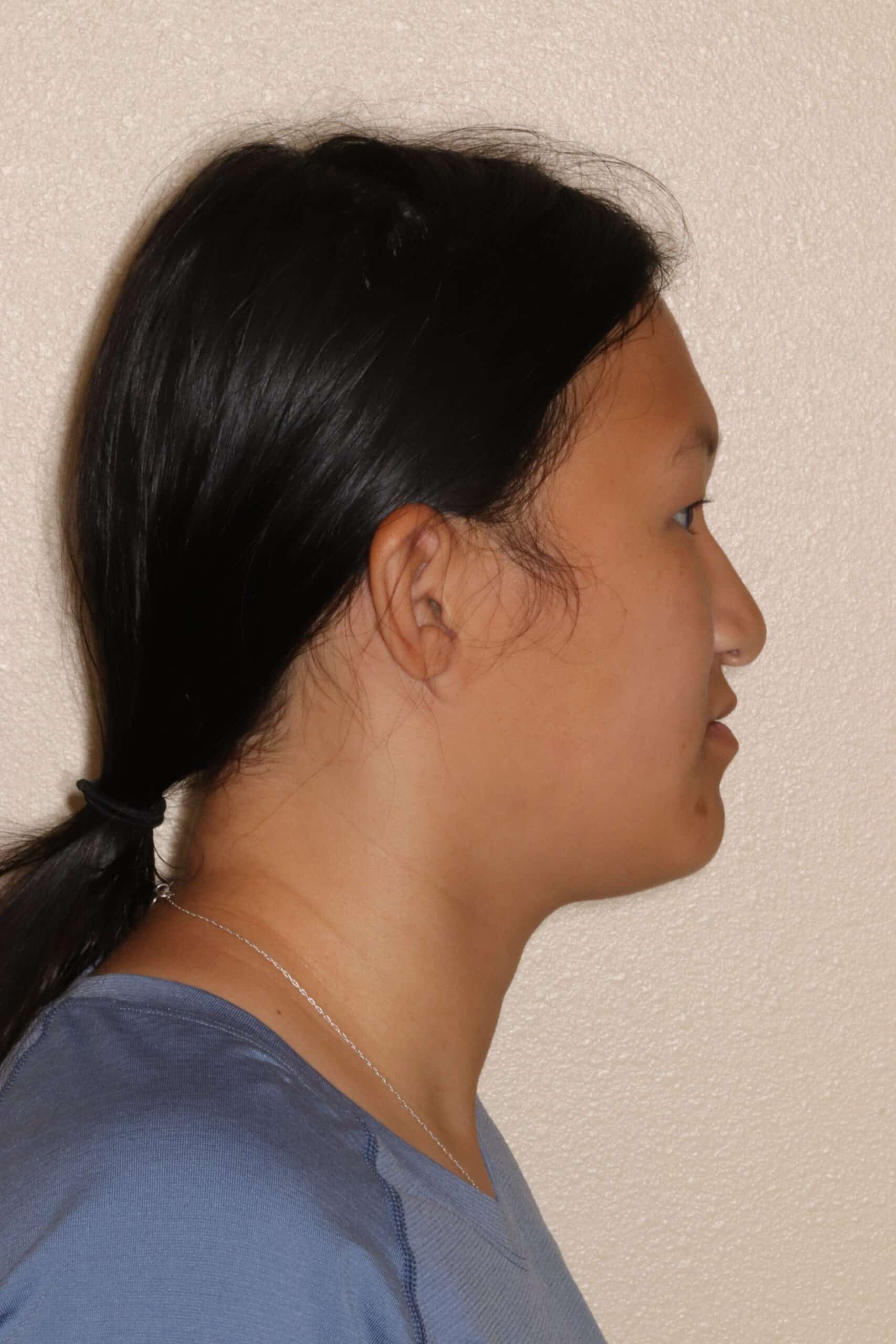 before profile