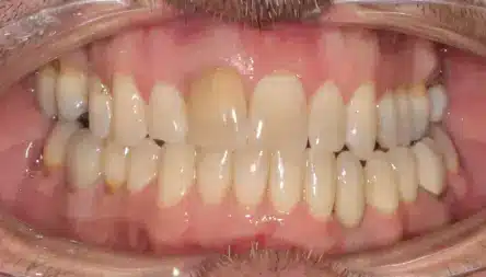 close up preop