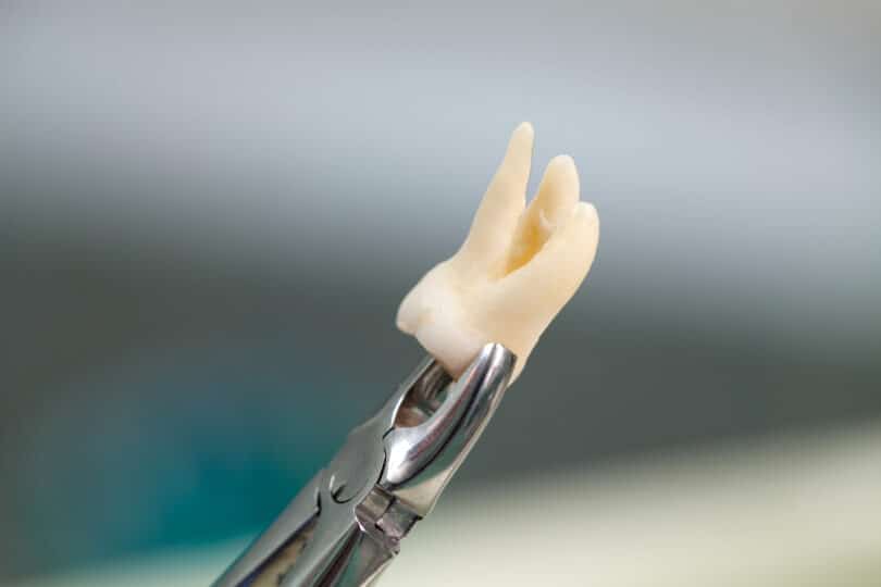 Wisdom Teeth Removal Fargo